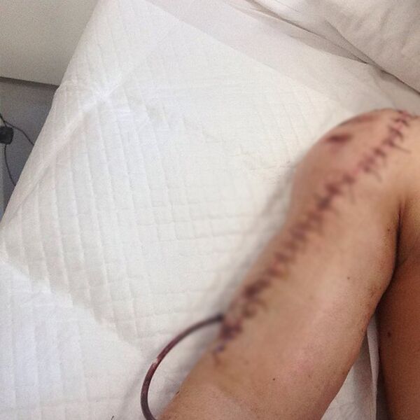 Файл:Вероятное ранение полученное неонацистом в результате боя за донецкий аэропорт.jpg